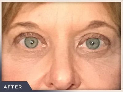 Blepharoplasty Before & After Patient #784