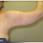 Brachioplasty Before & After Patient #764