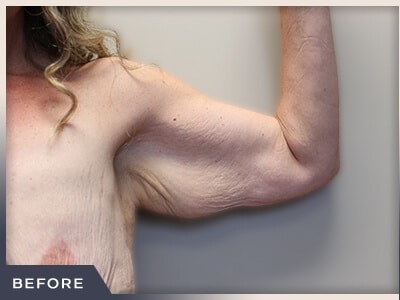 Brachioplasty Before & After Patient #764