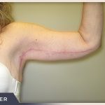 Brachioplasty Before & After Patient #764
