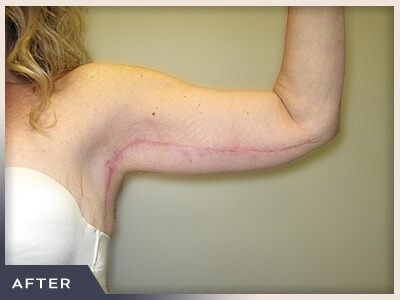 Brachioplasty Before & After Patient #764