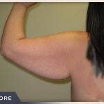 Brachioplasty Before & After Patient #1412