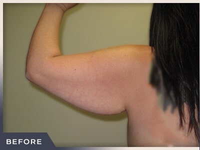 Brachioplasty Before & After Patient #1412