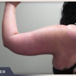 Brachioplasty Before & After Patient #1412
