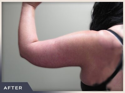 Brachioplasty Before & After Patient #1412