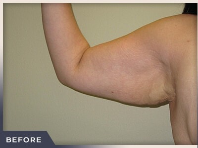 Brachioplasty Before & After Patient #1412