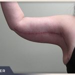 Brachioplasty Before & After Patient #1412