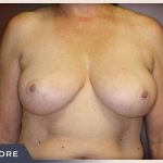 Breast Reduction Before & After Patient #503