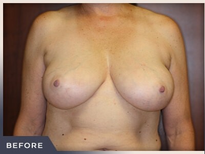 Breast Reduction Before & After Patient #503