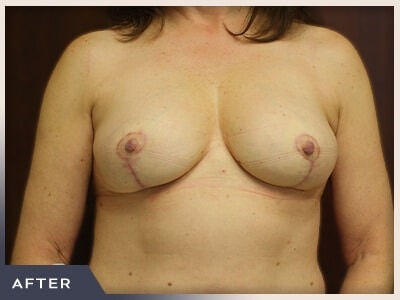 Breast Reduction Before & After Patient #503