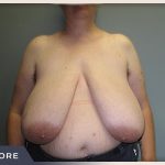 Breast Reduction Before & After Patient #511