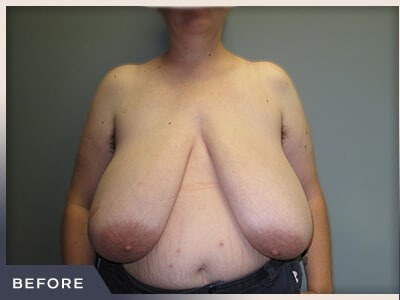 Breast Reduction Before & After Patient #511