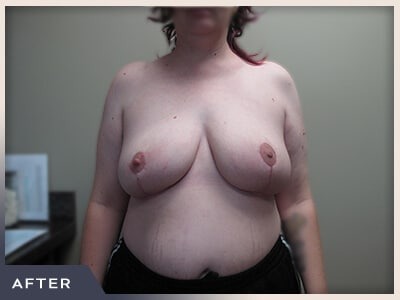Breast Reduction Before & After Patient #511