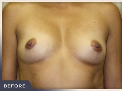 Breast Augmentation Before & After Patient #490