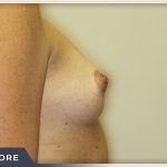 Breast Augmentation Before & After Patient #490