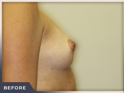 Breast Augmentation Before & After Patient #490