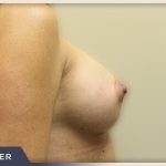 Breast Augmentation Before & After Patient #490
