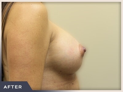 Breast Augmentation Before & After Patient #490