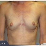 Breast Augmentation Before & After Patient #489
