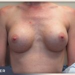 Breast Augmentation Before & After Patient #489
