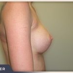 Breast Augmentation Before & After Patient #489