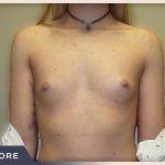 Breast Augmentation Before & After Patient #488