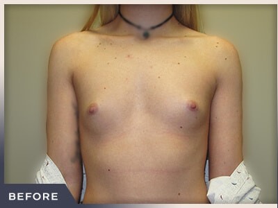 Breast Augmentation Before & After Patient #488