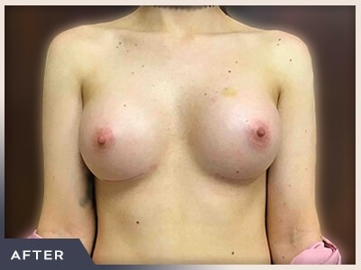 Breast Augmentation Before & After Patient #488
