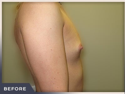 Breast Augmentation Before & After Patient #488