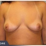 Breast Augmentation Before & After Patient #1411