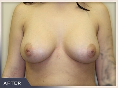 Breast Augmentation Before & After Patient #1411