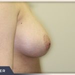 Breast Augmentation Before & After Patient #1411