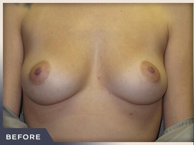 Breast Augmentation Before & After Patient #486