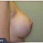 Breast Augmentation Before & After Patient #486