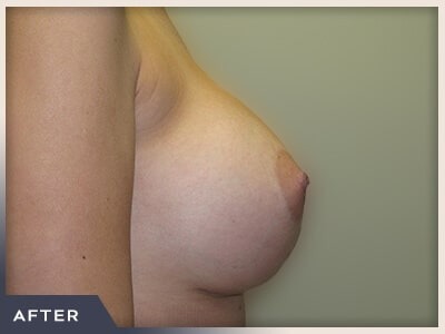Breast Augmentation Before & After Patient #486