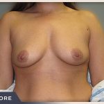 Breast Augmentation Before & After Patient #482