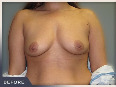 Breast Augmentation Before & After Patient #482