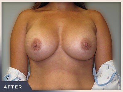 Breast Augmentation Before & After Patient #482