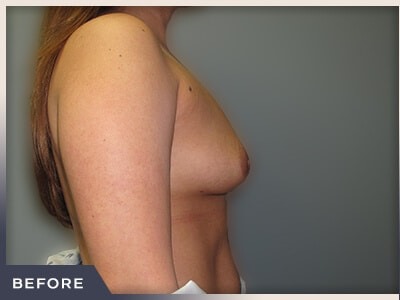 Breast Augmentation Before & After Patient #482