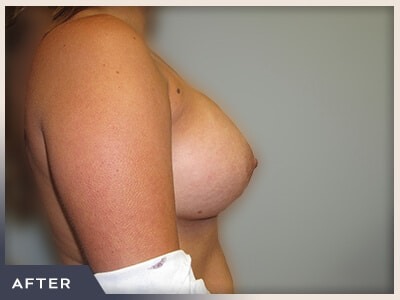Breast Augmentation Before & After Patient #482
