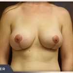Breast Lift Before & After Patient #514