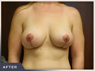 Breast Lift Before & After Patient #514
