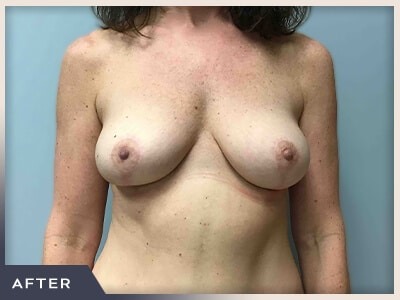 Breast Lift Before & After Patient #513