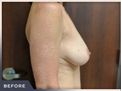 Breast Lift Before & After Patient #513