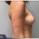 Breast Lift Before & After Patient #513