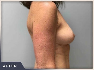 Breast Lift Before & After Patient #513