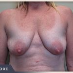 Breast Lift with Augmentation Before & After Patient #501