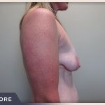 Breast Lift with Augmentation Before & After Patient #501
