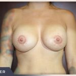 Breast Lift with Augmentation Before & After Patient #500