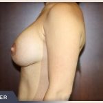 Breast Lift with Augmentation Before & After Patient #500